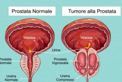 prostata con tumore