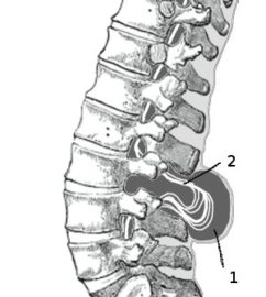 spina bifida colonna